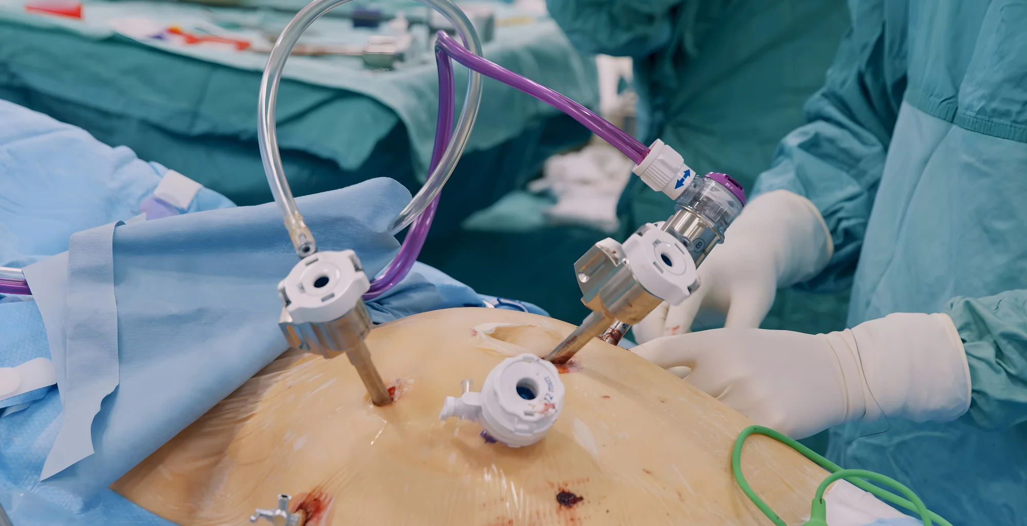 Dr. MD. Sabir Pasha - Laparoscopic Ovarian Cystectomy Specialist